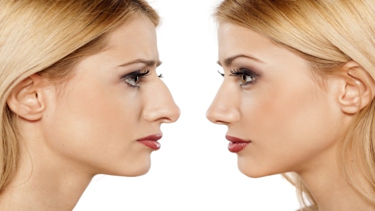 How to take care of yourself before and after rhinoplasty