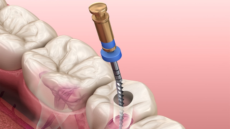 When Should I Go for Root Canal Treatment?